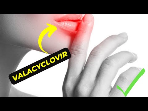 Valacyclovir: The Antiviral Medication That Can Help Treat Herpes and Cold Sores