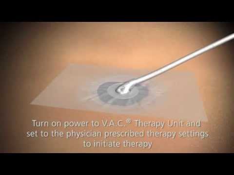KCI VAC Dressing Application Overview M