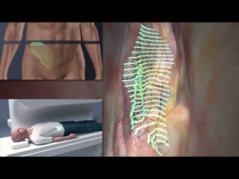 DynaMesh® - ENDOLAP visible von FEG