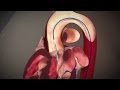 Heart Edwards Sapien Transcatheter Heart Valve With RetroFlex 3 Transfemoral System