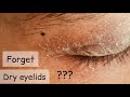 Dryness On Eyelids And Face Simple Home Remedy Dry Skin Around Eyelids Treatment