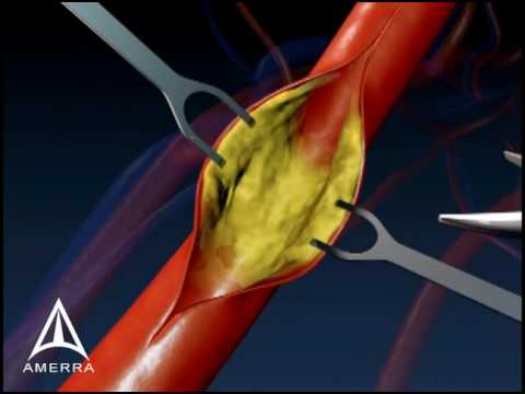 Carotid Endarectomy - 3D Medical Animation