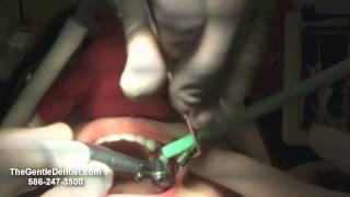 preview picture of video 'Shelby Twp dentist replaces replaces root canal with dental implant'