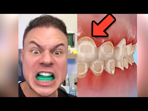 Can You Whiten Your Teeth With Braces? Experiment Update!