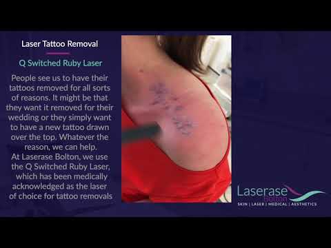 Laser Tattoo Removal- How Laser Tattoo Removal Works