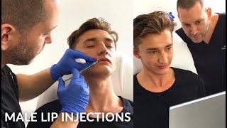 Young Man Getting Lip Enhancement Treatment | Male Lip Injections with Dr. Jason Emer