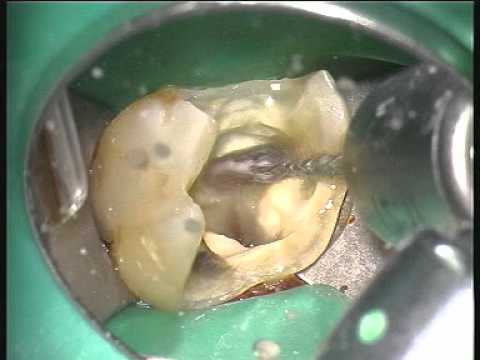 Amoxiclav und Prostatitis Ein Brennen in der Harnröhre der Prostata