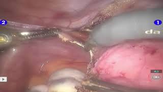 Robotic Hysterectomy, UK