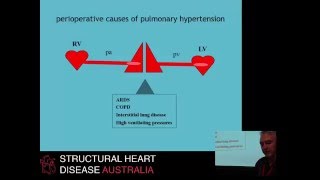 Peri-operative management of pulmonary hypertension – Prof Paul Forrest