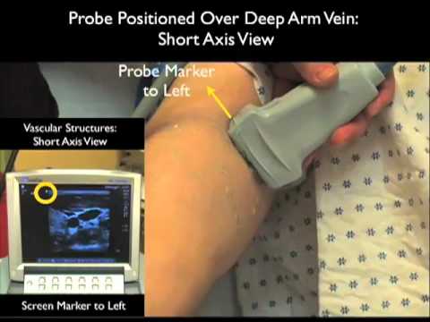 How to: Peripheral Venous Access Under Ultrasound Guidance Case Study Part 1