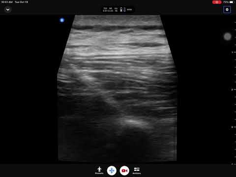 Erector Spinae plane (ESP) block at Th 12 level for spine fusion surgery