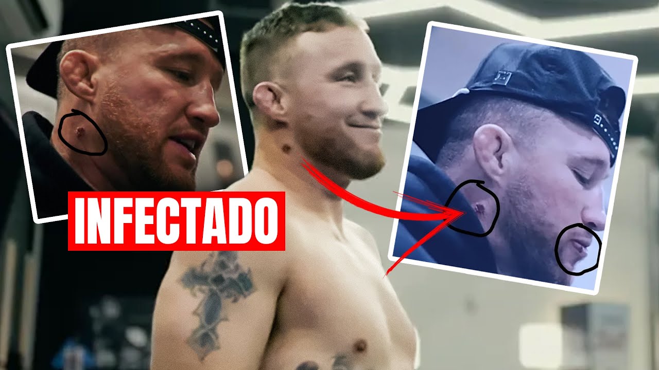 Justin Gaethje tiene una INFECCIÓN!!!