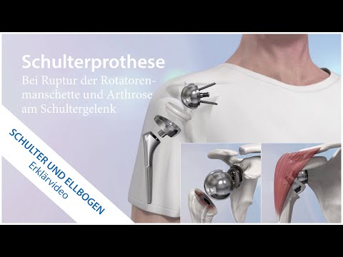 Schulterprothese bei Arthrose am Schultergelenk
