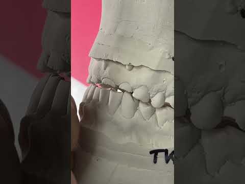 This is how we do for full mouth rehabilitation planning