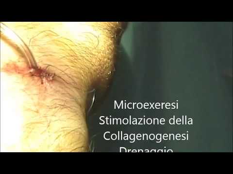 Come ottenere un preventivo per la sostituzione intervento chirurgico al ginocchio a Mosca Benda per il trattamento della colonna vertebrale