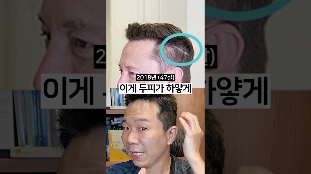 세계 1위 부자 일론 머스크도 대머리 직전까지 갔었다?