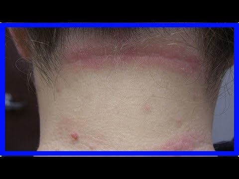 Das Streptozid bei der Schuppenflechte die Rezensionen Die allergische Diathese und atopitscheski die Hautentzündung