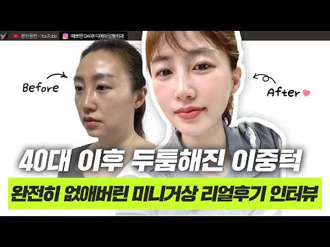40대 미니거상으로 나의 전성기 시절 미모로 컴백!ㅣ디에이성형외과 ㅣ40대미니거상실제후기
