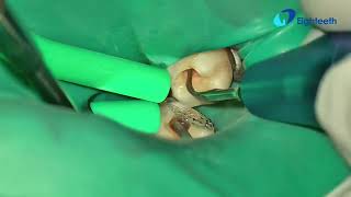 POV clinical presentation of RCT of tooth 31 from start to finish, unedited. 
