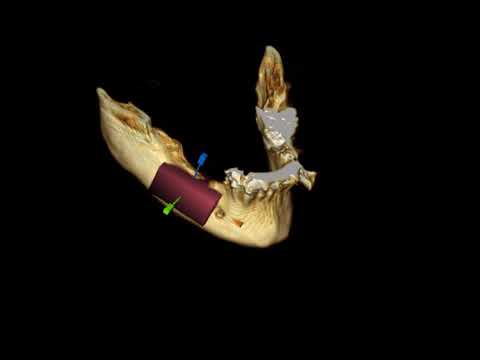 OneScan FullDigital BoneGraft