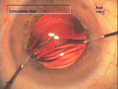 Membrane Optic Capture