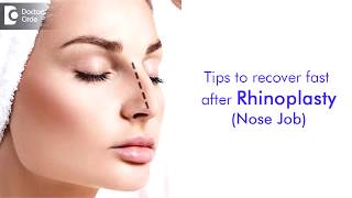 How to make bruises go away faster after rhinoplasty? - Dr.Harihara Murthy
