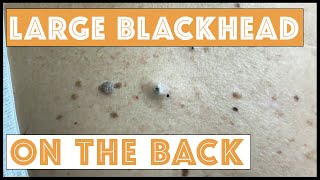 Extracting Big Blackheads on the Back:  A popaholic couple married over 50 years!