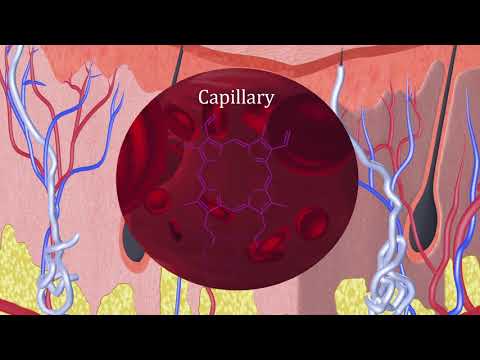 What is erythropoietic protoporphyria (EPP)?