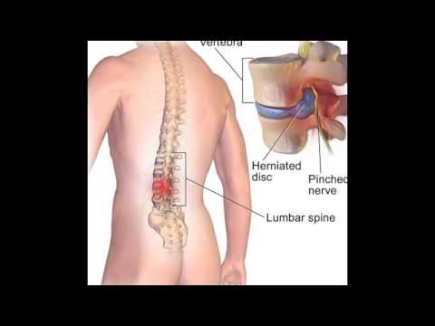 Mal di testa osteocondrosi cosa fare Giunti di anastrozolo