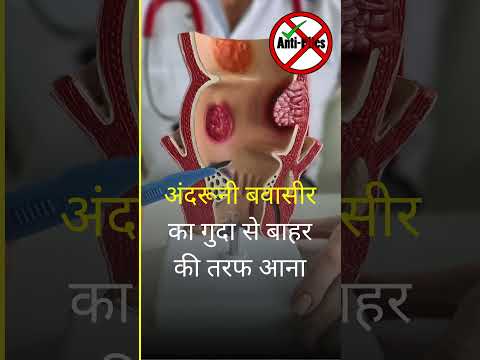 अंदरूनी बवासीर के लक्षण?  #antipiles #doctor #piles #antipiles #piles #hemorrhoidstreatment
