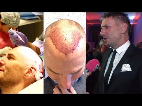 KOLEJNE ampułki przeciw wypadaniu włosów Łopian olej z propolisem Łysienie