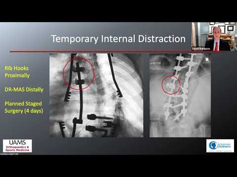 Lecture: Pediatric Spinal Deformity - Techniques for Challenging Cases