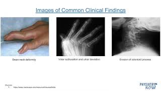 Rheumatology I  - Rheumatoid Arthritis