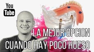 EL MEJOR TIPO DE PROTESIS CON POCO HUESO Y POCO DINERO