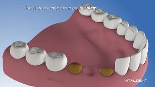 Vitaldent Prótesis Dental Fija v2 anuncio
