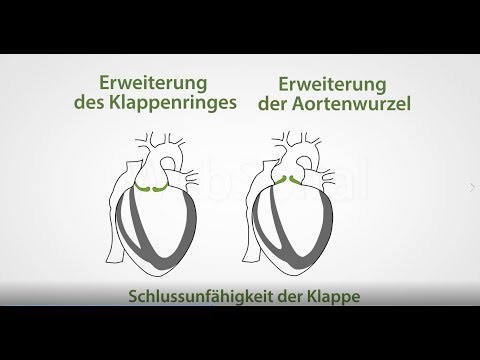 Blutdruck Physische Rehabilitation von Patienten mit essentieller Hypertonie