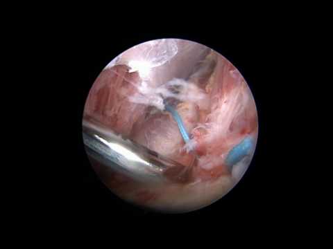 Schmerzen in den Lymphknoten im Hals und Schmerzen im Hals Krank während Hüftendoprothetik