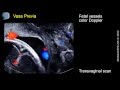 Vasa Previa - ultrasound diagnosis