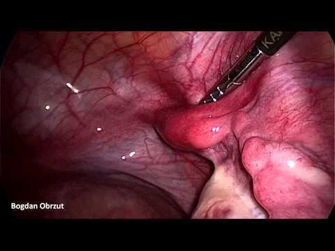 Diagnostic laparoscopy (MRK syndrome - vaginal and uterine agenesis)