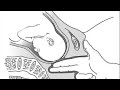 Vaginal Exam In Labor What Do We Do