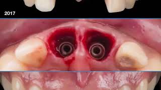 ≫ RECUPERANDO UNA HERMOSA SONRISA CON IMPLANTES DENTALES! ✨