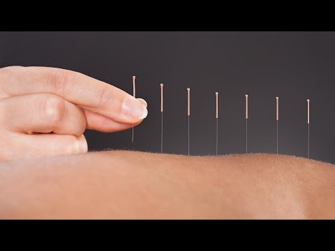 The Science Behind How Acupuncture Helps Relieve Pain: A Doctor Of Chinese Medicine Explains