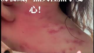 Download lagu Wind-pulling and scraping therapy - kerokan #kerokan #揪痧 pulling mp3 Download lagu Wind-pulling and scraping therapy - kerokan #kerokan #揪痧 pulling mp3
