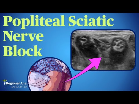 RA & Acute Pain Medicine (Popliteal)