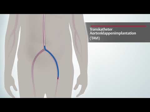Transkatheter-Aortenklappenimplantation (TAVI)