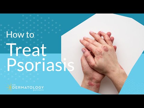 Psoriasis Treatment - Explained by Dermatologist