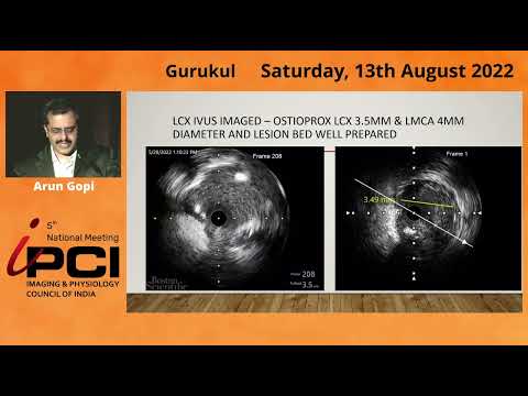 DR.ARUN GOPI- OSTIAL LCX ISR POST OSTIAL LAD REMOTE STENTING
