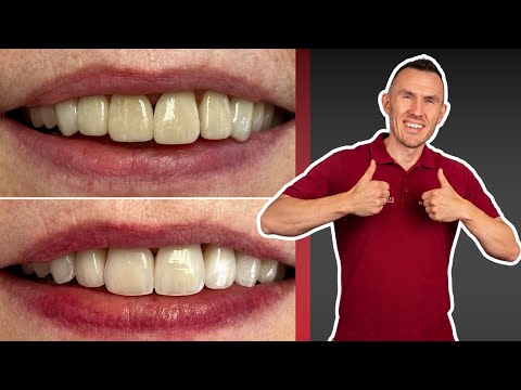 Veneers auf den Zähnen entfernen und erneuern? GEHT! Spannender Vorher / Nachher Patientenfall!