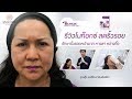 โบท็อก ลดริ้วรอย