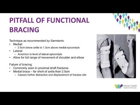 Humeral Shaft Fractures   Is Sarmiento's Paper Still Relevant by Dr Dharsh Musiienko